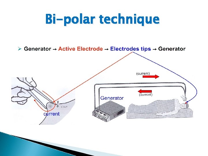 Bi-polar technique 