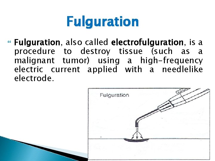 Fulguration Fulguration, also called electrofulguration, is a procedure to destroy tissue (such as a