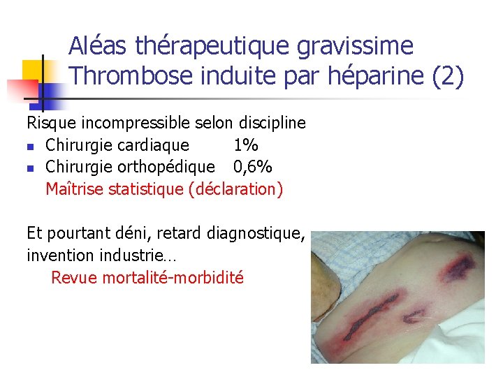 Aléas thérapeutique gravissime Thrombose induite par héparine (2) Risque incompressible selon discipline n Chirurgie