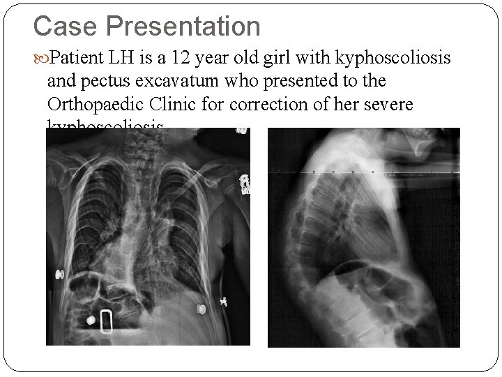 Case Presentation Patient LH is a 12 year old girl with kyphoscoliosis and pectus