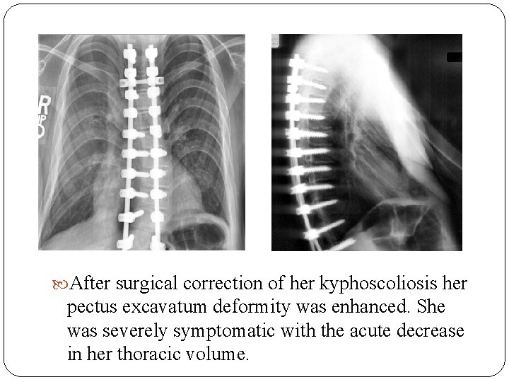  After surgical correction of her kyphoscoliosis her pectus excavatum deformity was enhanced. She