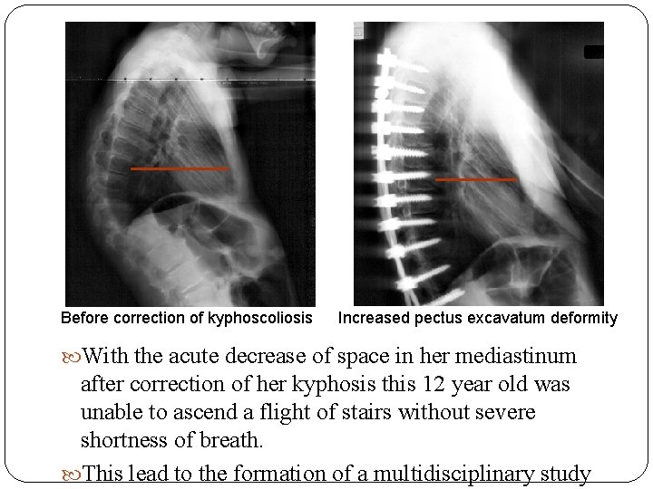 Before correction of kyphoscoliosis Increased pectus excavatum deformity With the acute decrease of space