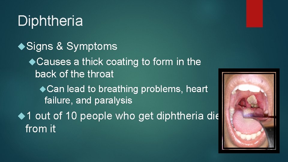 Diphtheria Signs & Symptoms Causes a thick coating to form in the back of
