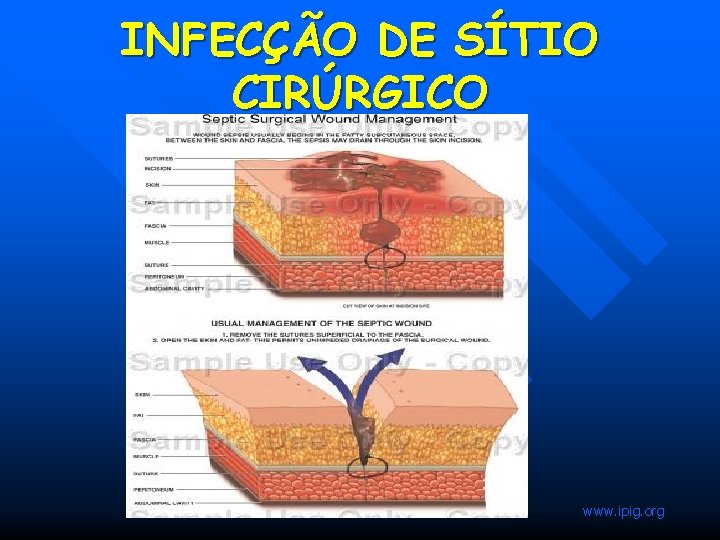 INFECÇÃO DE SÍTIO CIRÚRGICO www. ipig. org INFECÇÃO DE SÍTIO CIRÚRGICO www. ipig. org