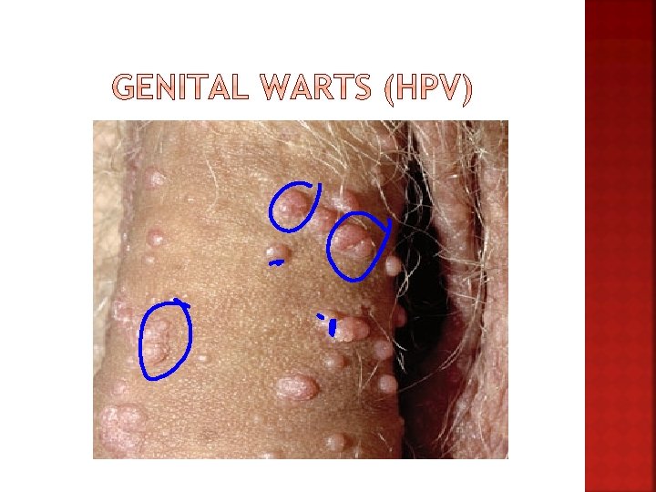 hpv and genital itching)