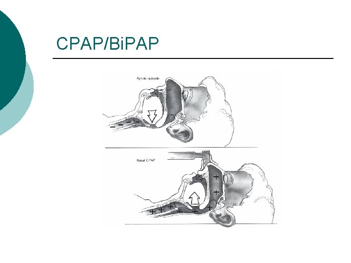Obstructive Sleep Apnea Melanie Giesler DO Patient Evaluation