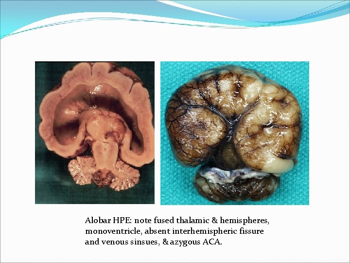 Alobar HPE: note fused thalamic & hemispheres, monoventricle, absent interhemispheric fissure and venous sinsues, Alobar HPE: note fused thalamic & hemispheres, monoventricle, absent interhemispheric fissure and venous sinsues,