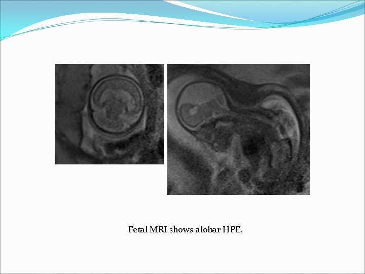 Fetal MRI shows alobar HPE. Fetal MRI shows alobar HPE.