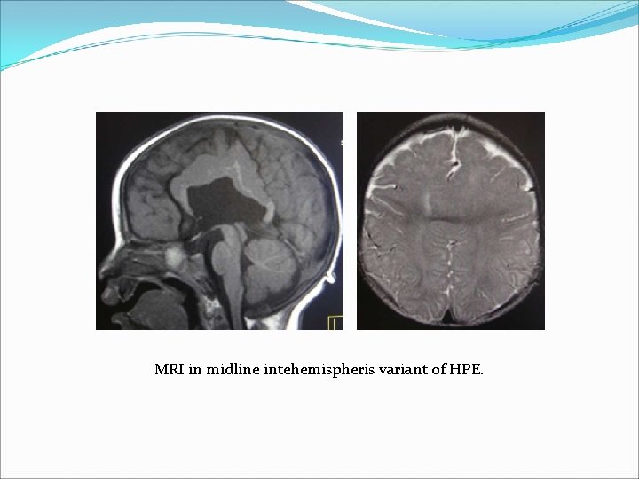 MRI in midline intehemispheris variant of HPE. MRI in midline intehemispheris variant of HPE.