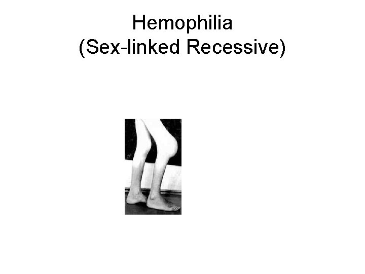 Hemophilia (Sex-linked Recessive) 