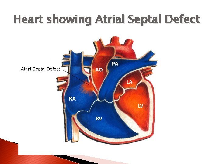 Heart showing Atrial Septal Defect 