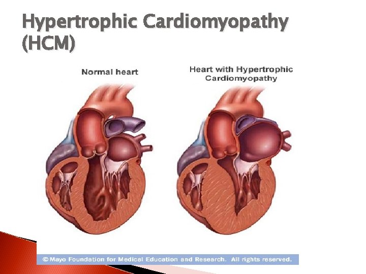 Hypertrophic Cardiomyopathy (HCM) 