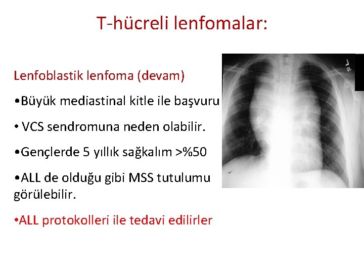 T-hücreli lenfomalar: Lenfoblastik lenfoma (devam) • Büyük mediastinal kitle ile başvuru • VCS sendromuna T-hücreli lenfomalar: Lenfoblastik lenfoma (devam) • Büyük mediastinal kitle ile başvuru • VCS sendromuna