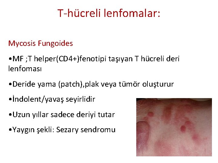 T-hücreli lenfomalar: Mycosis Fungoides • MF ; T helper(CD 4+)fenotipi taşıyan T hücreli deri T-hücreli lenfomalar: Mycosis Fungoides • MF ; T helper(CD 4+)fenotipi taşıyan T hücreli deri