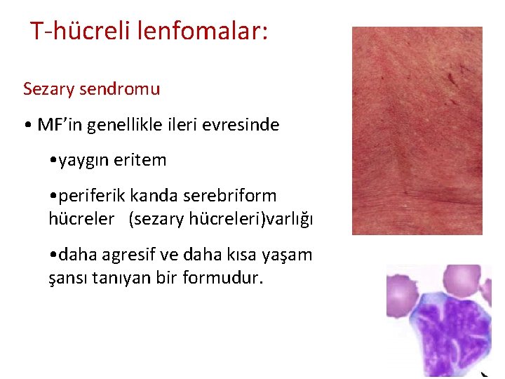 T-hücreli lenfomalar: Sezary sendromu • MF’in genellikle ileri evresinde • yaygın eritem • periferik T-hücreli lenfomalar: Sezary sendromu • MF’in genellikle ileri evresinde • yaygın eritem • periferik
