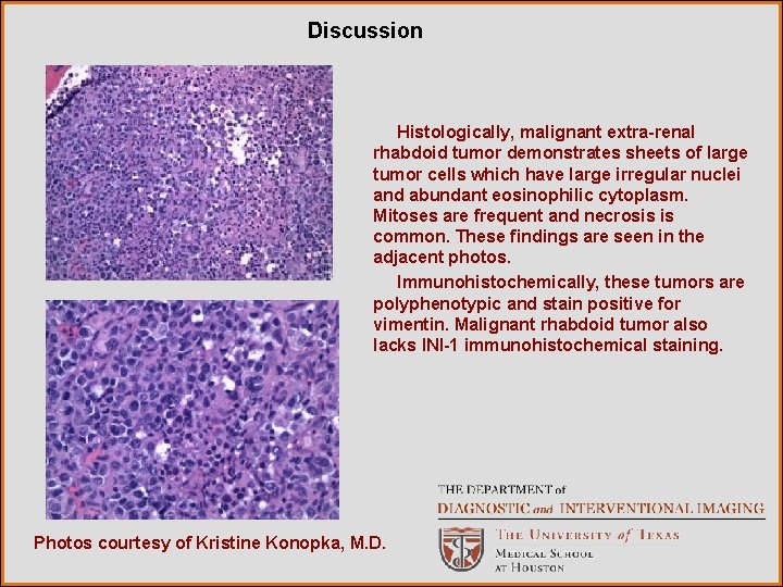 Discussion Histologically, malignant extra-renal rhabdoid tumor demonstrates sheets of large tumor cells which have