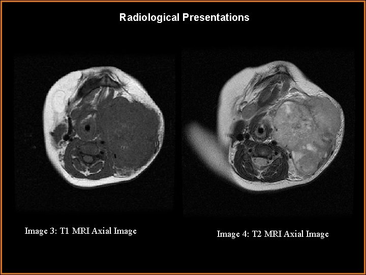 Radiological Presentations Image 3: T 1 MRI Axial Image 4: T 2 MRI Axial