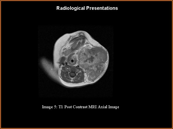 Radiological Presentations Image 5: T 1 Post Contrast MRI Axial Image 