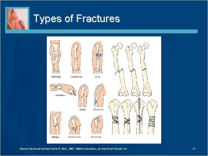 Types of Fractures Elsevier items and derived items © 2011, 2007, 2006 by Saunders,