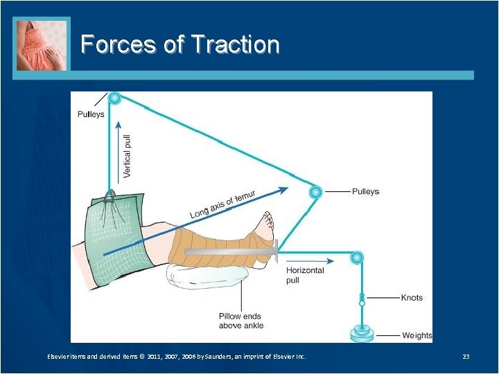 Forces of Traction Elsevier items and derived items © 2011, 2007, 2006 by Saunders,