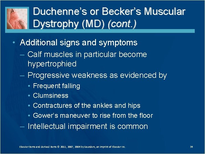 Duchenne’s or Becker’s Muscular Dystrophy (MD) (cont. ) • Additional signs and symptoms –