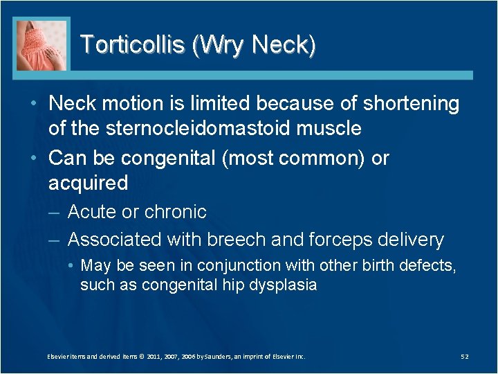 Torticollis (Wry Neck) • Neck motion is limited because of shortening of the sternocleidomastoid