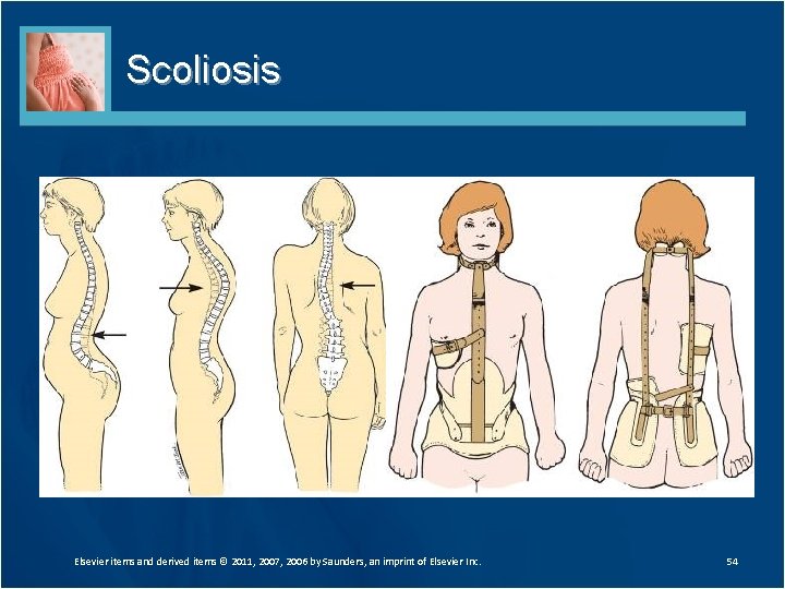 Scoliosis Elsevier items and derived items © 2011, 2007, 2006 by Saunders, an imprint