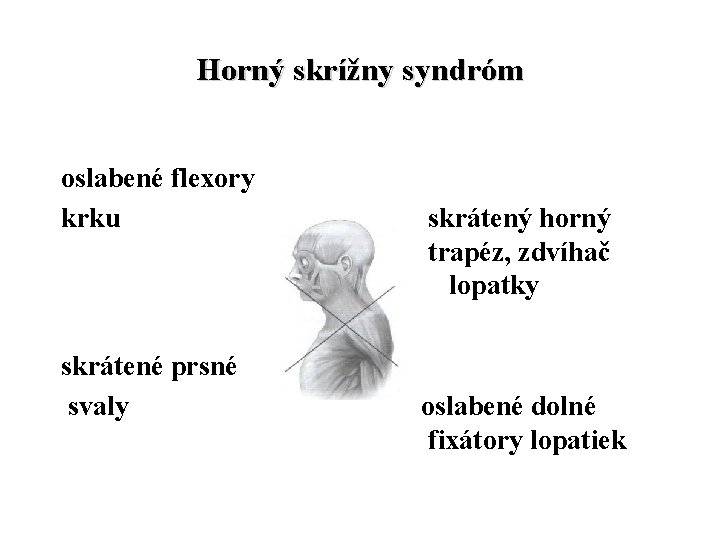 Horný skrížny syndróm oslabené flexory krku skrátené prsné svaly skrátený horný trapéz, zdvíhač lopatky