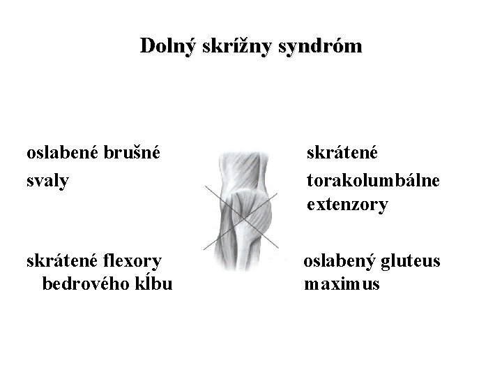 Dolný skrížny syndróm oslabené brušné svaly skrátené torakolumbálne extenzory skrátené flexory bedrového kĺbu oslabený