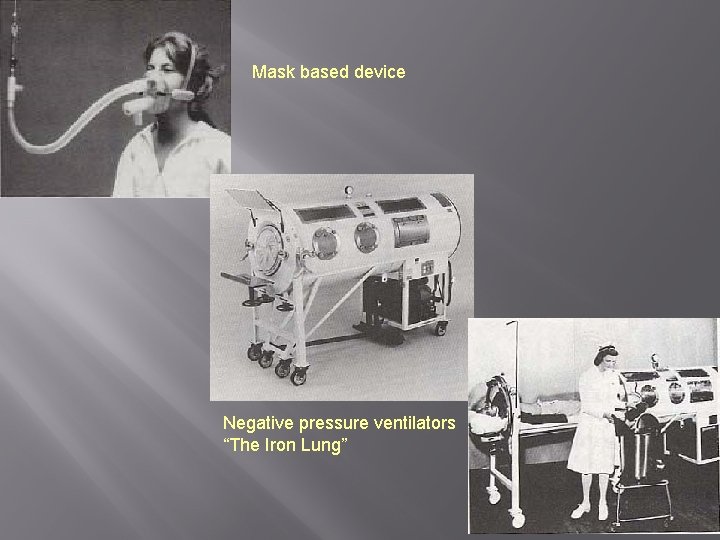 Mask based device Negative pressure ventilators “The Iron Lung” 