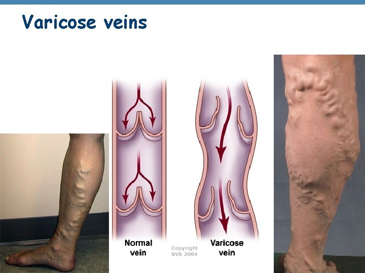 Varicose veins © 2012 Pearson Education, Inc. 