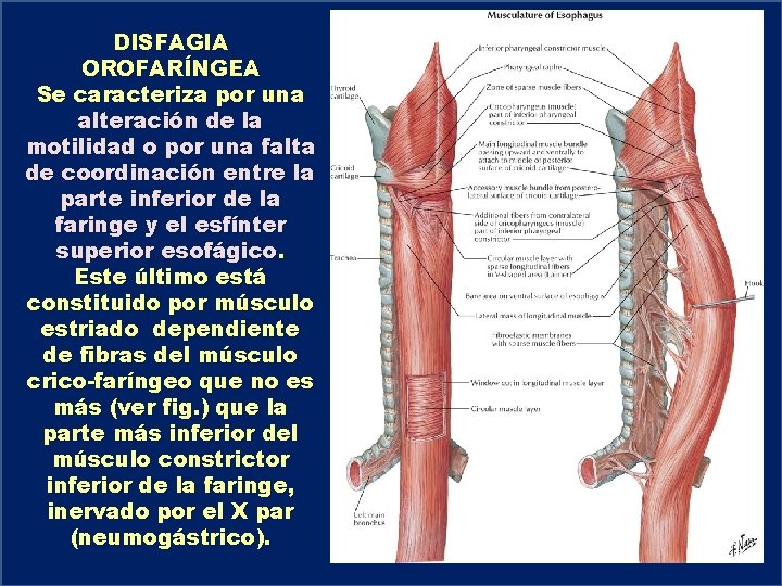 DISFAGIA OROFARÍNGEA Se caracteriza por una alteración de la motilidad o por una falta