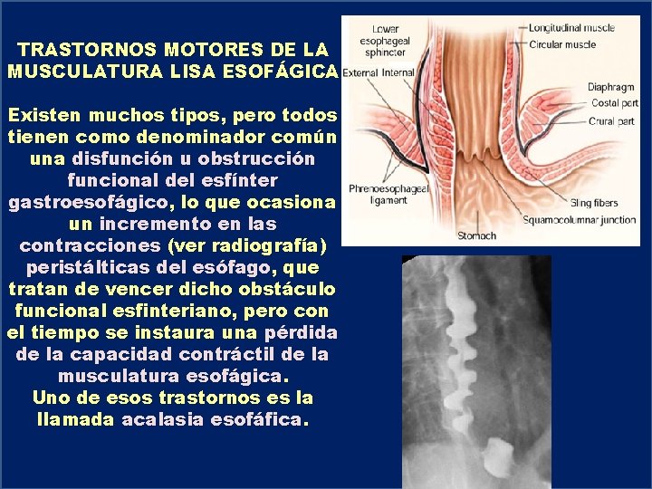 TRASTORNOS MOTORES DE LA MUSCULATURA LISA ESOFÁGICA Existen muchos tipos, pero todos tienen como