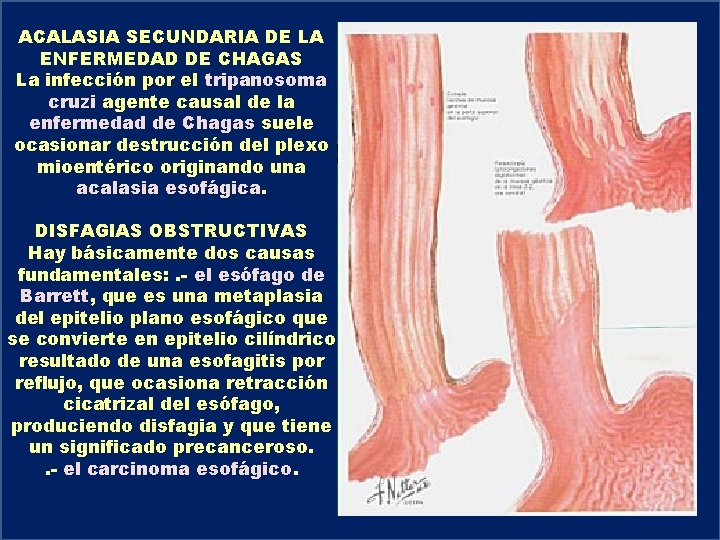 ACALASIA SECUNDARIA DE LA ENFERMEDAD DE CHAGAS La infección por el tripanosoma cruzi agente