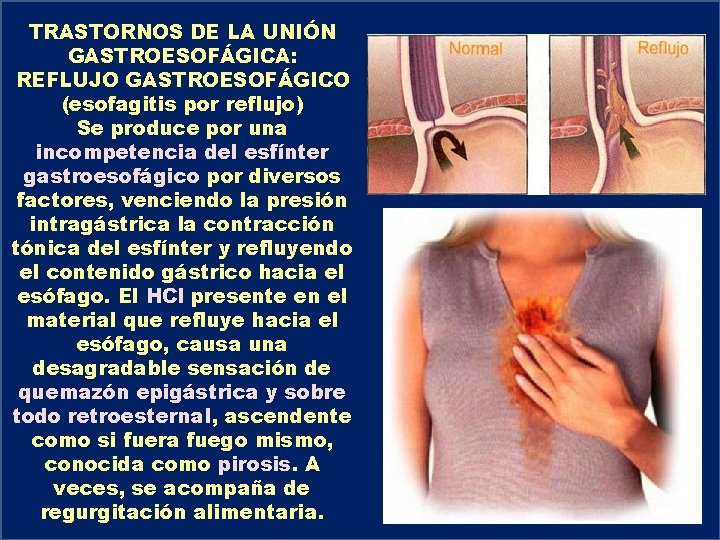 TRASTORNOS DE LA UNIÓN GASTROESOFÁGICA: REFLUJO GASTROESOFÁGICO (esofagitis por reflujo) Se produce por una