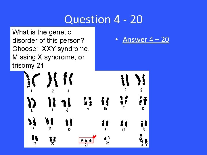 Question 4 - 20 What is the genetic disorder of this person? Choose: XXY
