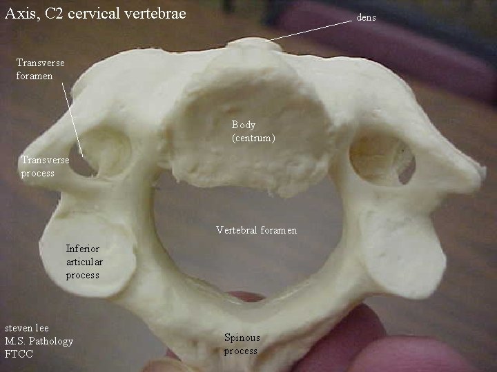 Axis, C 2 cervical vertebrae dens Transverse foramen Body (centrum) Transverse process Vertebral foramen