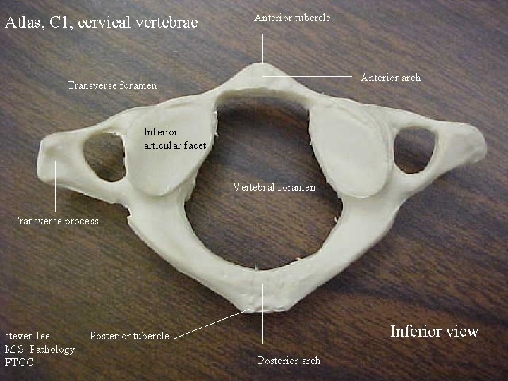 Atlas, C 1, cervical vertebrae Anterior tubercle Anterior arch Transverse foramen Inferior articular facet