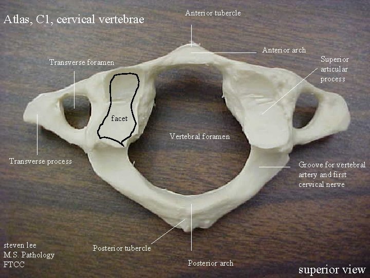Atlas, C 1, cervical vertebrae Anterior tubercle Anterior arch Superior articular process Transverse foramen