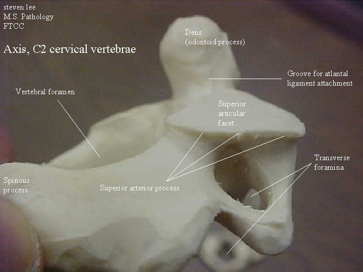 steven lee M. S. Pathology FTCC Axis, C 2 cervical vertebrae Dens (odontoid process)