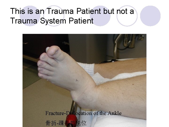 This is an Trauma Patient but not a Trauma System Patient Fracture-Dislocation of the