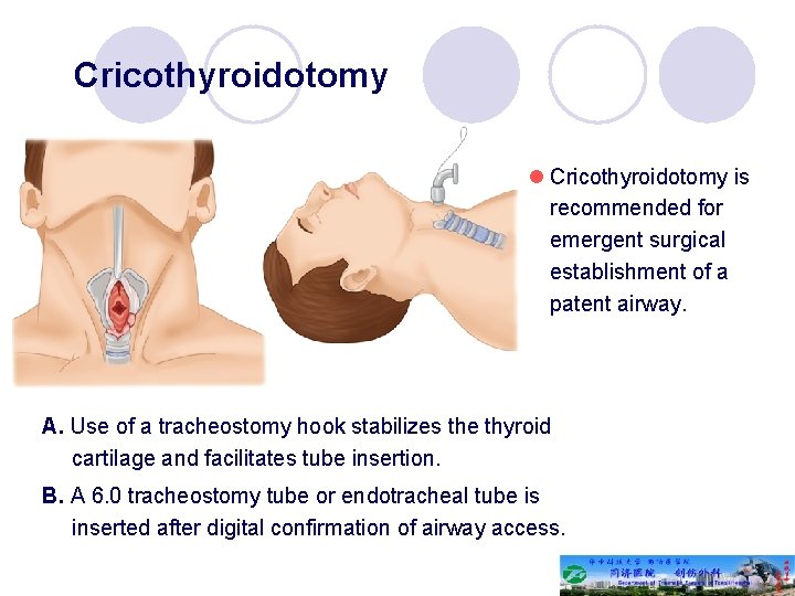 Cricothyroidotomy l Cricothyroidotomy is recommended for emergent surgical establishment of a patent airway. A.