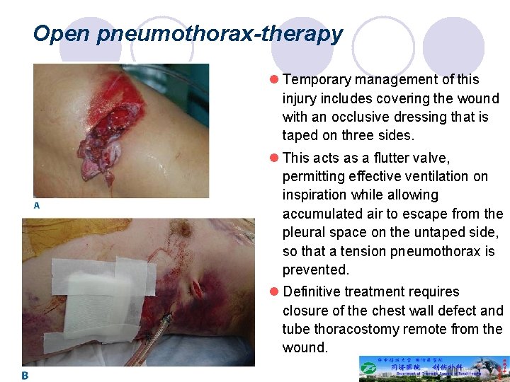 Open pneumothorax-therapy l Temporary management of this injury includes covering the wound with an