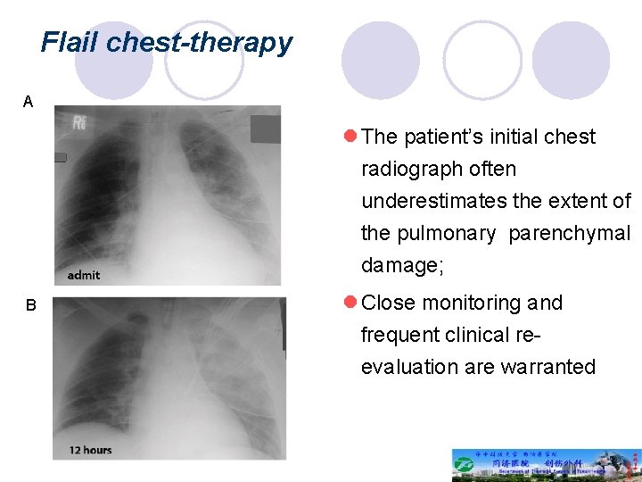 Flail chest-therapy A l The patient’s initial chest radiograph often underestimates the extent of