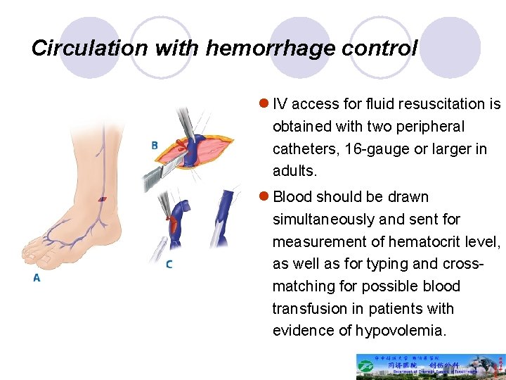 Circulation with hemorrhage control l IV access for fluid resuscitation is obtained with two