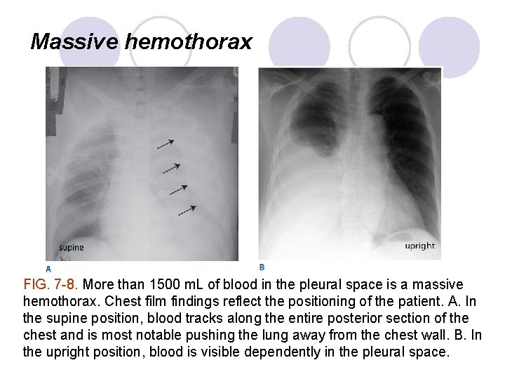 Massive hemothorax FIG. 7 -8. More than 1500 m. L of blood in the