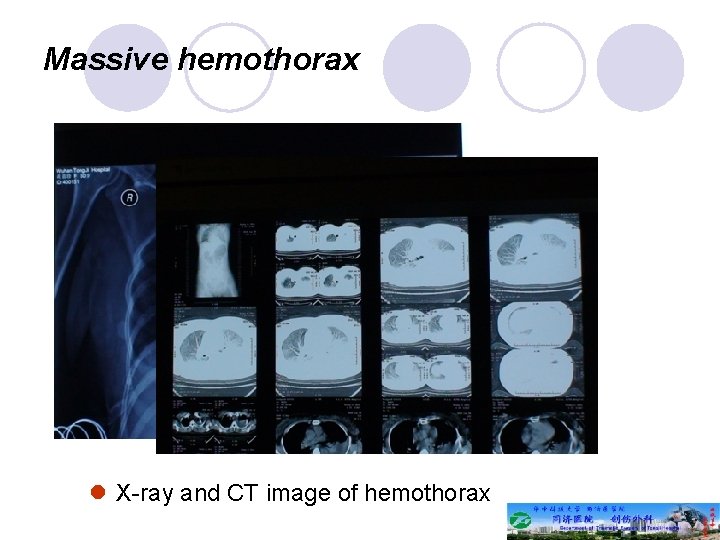 Massive hemothorax l X-ray and CT image of hemothorax 