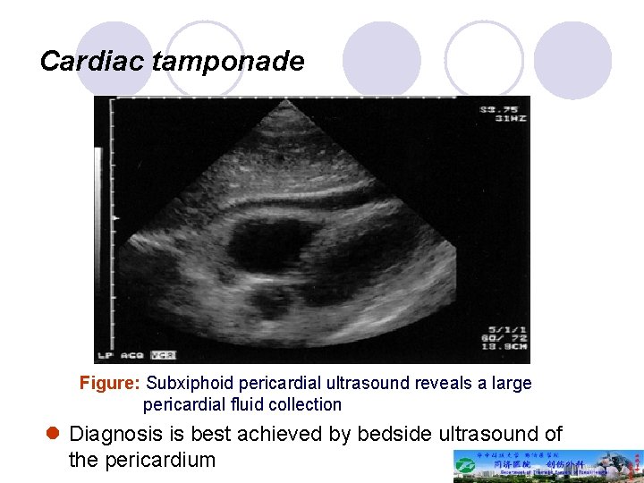 Cardiac tamponade Figure: Subxiphoid pericardial ultrasound reveals a large pericardial fluid collection l Diagnosis