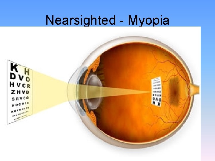 Nearsighted - Myopia 