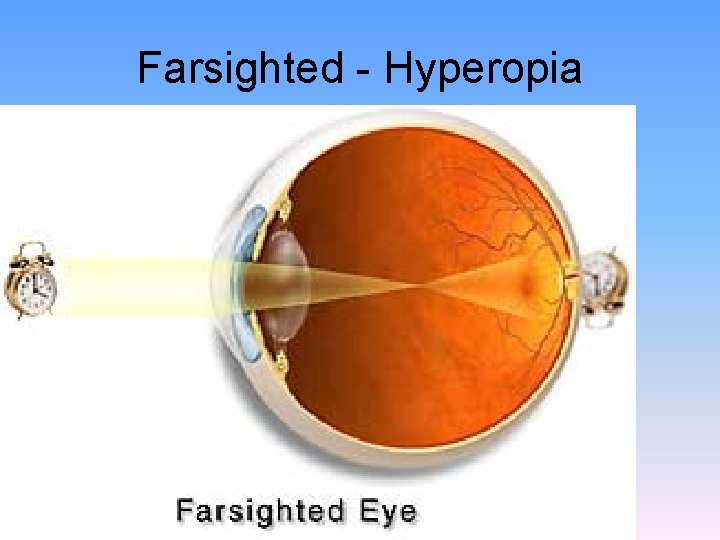 Farsighted - Hyperopia 